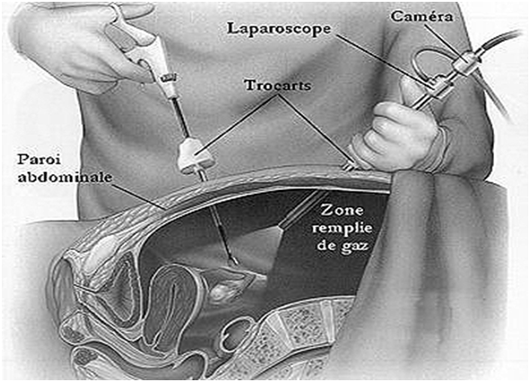 Coelioscopie ou laparoscopie - Centre de chirurgie gynécologique ...